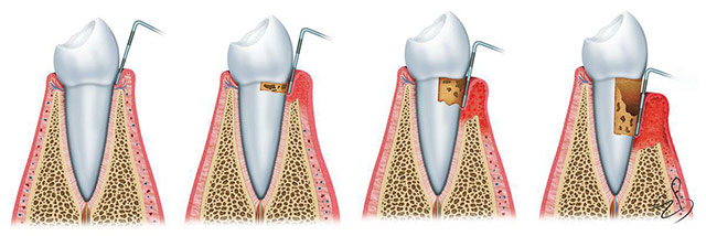 Diş Temizletmek Dişlere Zarar Verir mi?