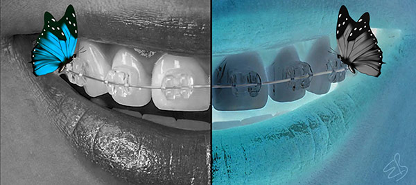 Ortodonti Gülüş Tasarımı Ankara